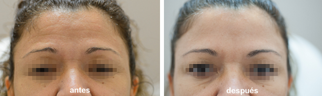 Eliminación de las lineas de expresión facial usando Botox, antes y después