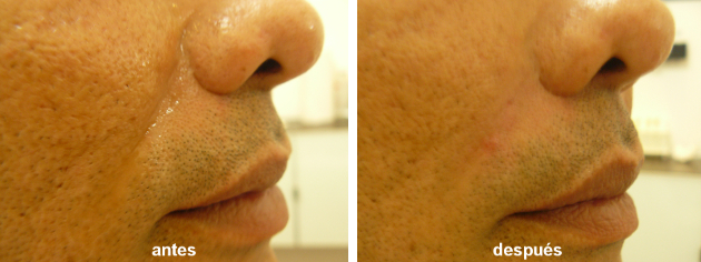 Bioplastía - Relleno de arrugas, antes y después