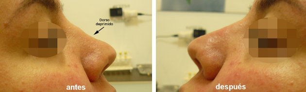 Rinomodelación no quirúrgica (Corrección de dorso deprimido), antes y después