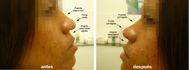 Rinoplastia sin cirugía o Rinomodelación (Corrección de perfil nasal), antes y después